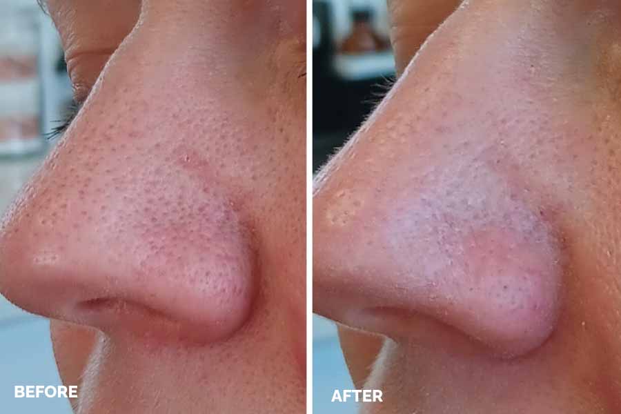 Before and after images showcasing the transformation of a woman's nose, highlighting the changes in shape and appearance.