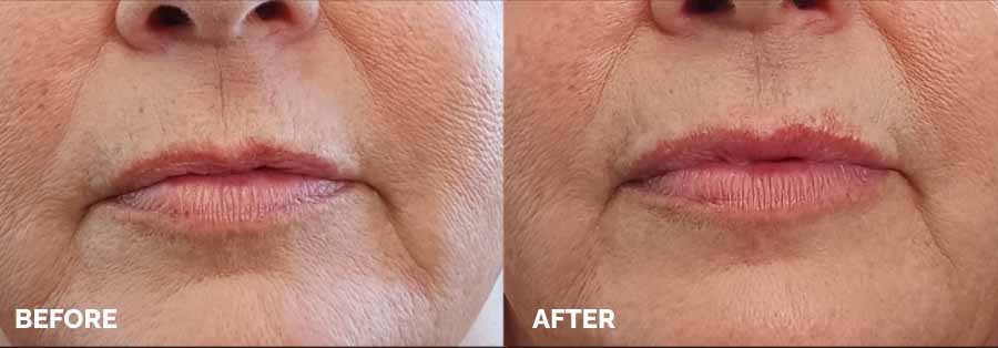 Before and after images showcasing the results of a lip lift procedure, highlighting enhanced lip volume and shape.