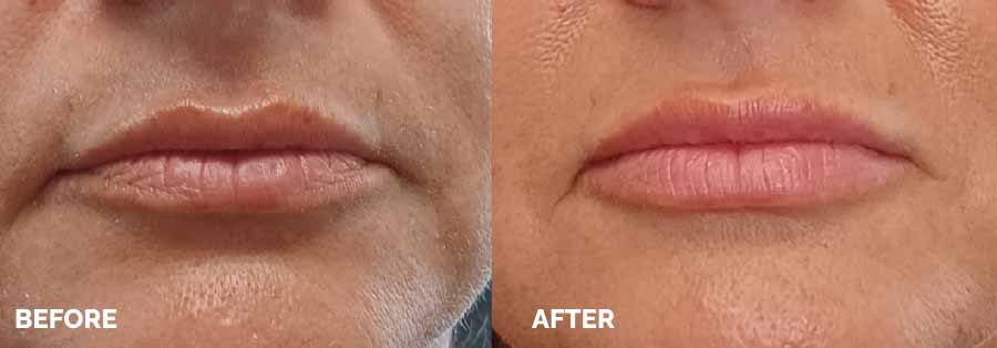 Comparative images illustrating the transformation achieved through a lip lift, emphasizing improved lip contour and fullness.