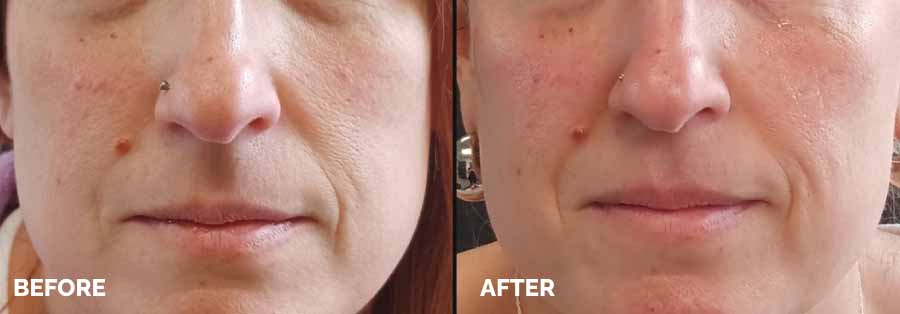 Before and after images showcasing a woman's facial transformation, highlighting significant changes in appearance.