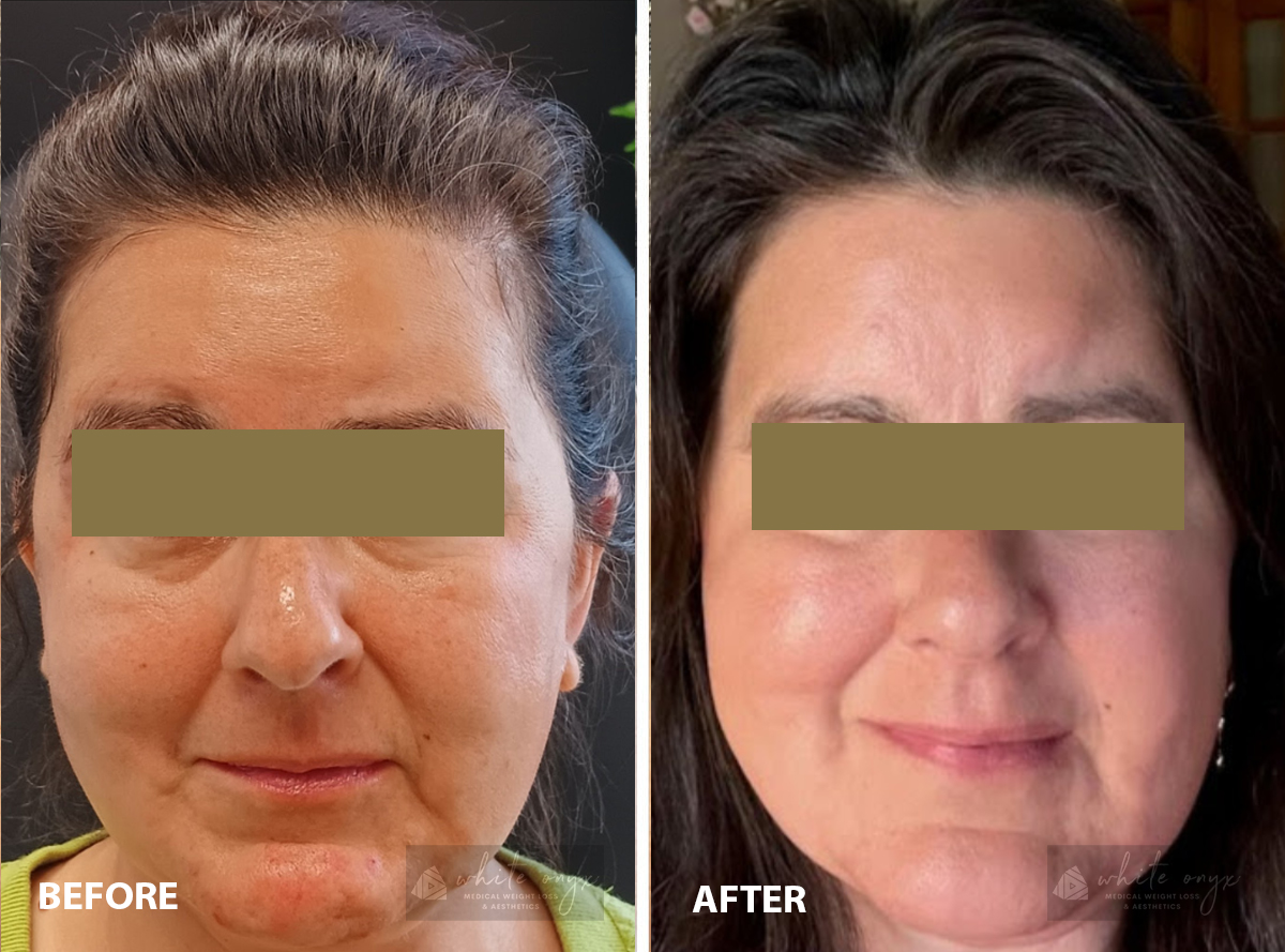 Before and after images showcasing the transformation of a woman's forehead, highlighting visible improvements in skin texture.