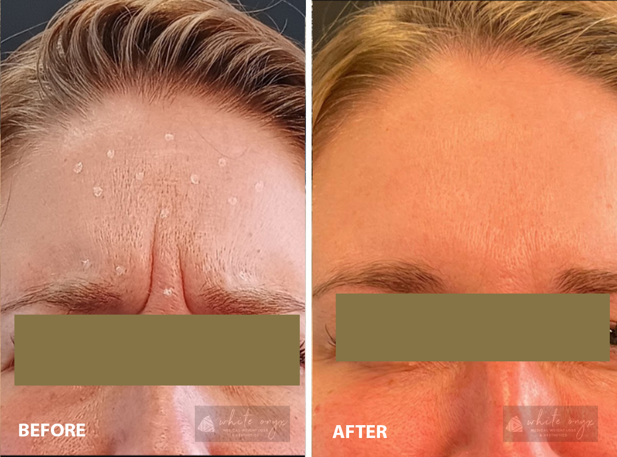Before and after images showcasing the transformation of a woman's forehead, highlighting visible improvements in skin texture.