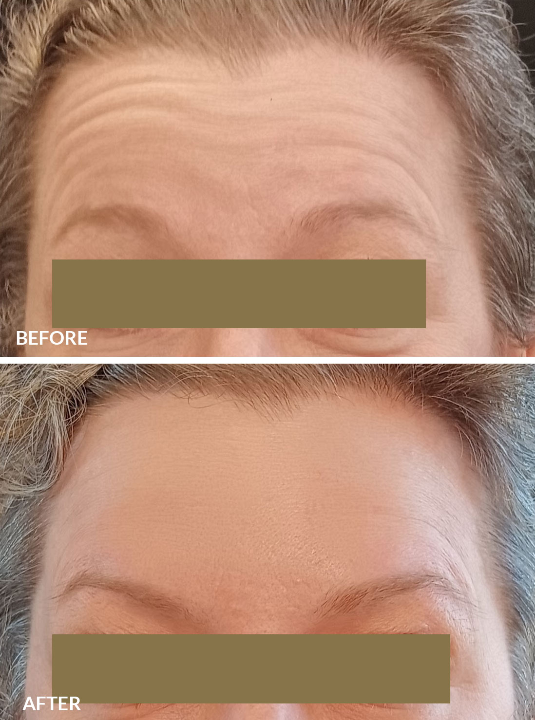 Chemical peels