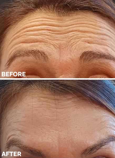Before After 4