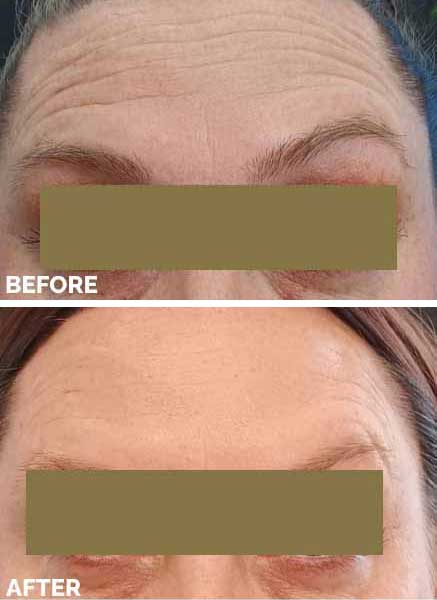 Before After 6