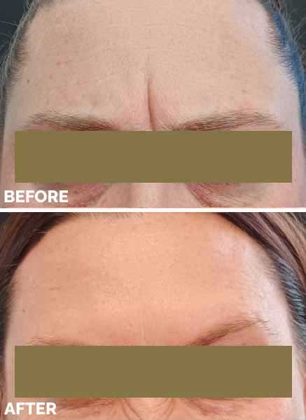 Before After 7