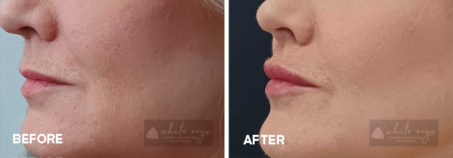 Lips Filler Before After Results Case - 3