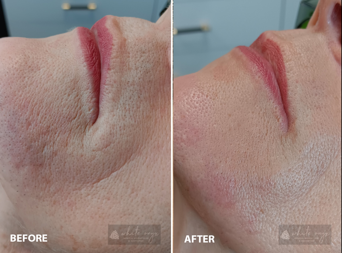 Side-by-side images of a woman's face, depicting the differences in her appearance before and after treatment.