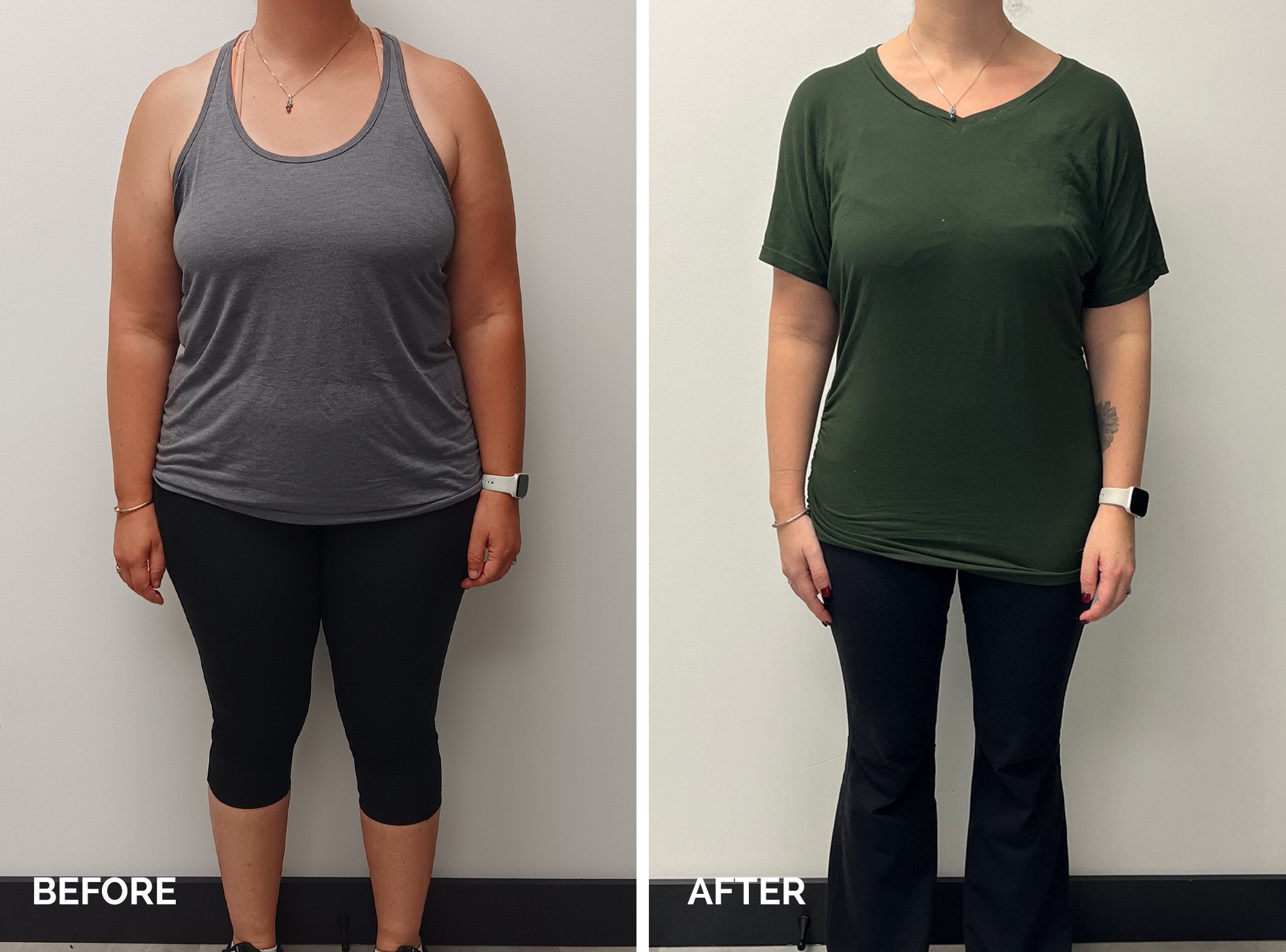 Medical Weight Loss - Before and After - 1