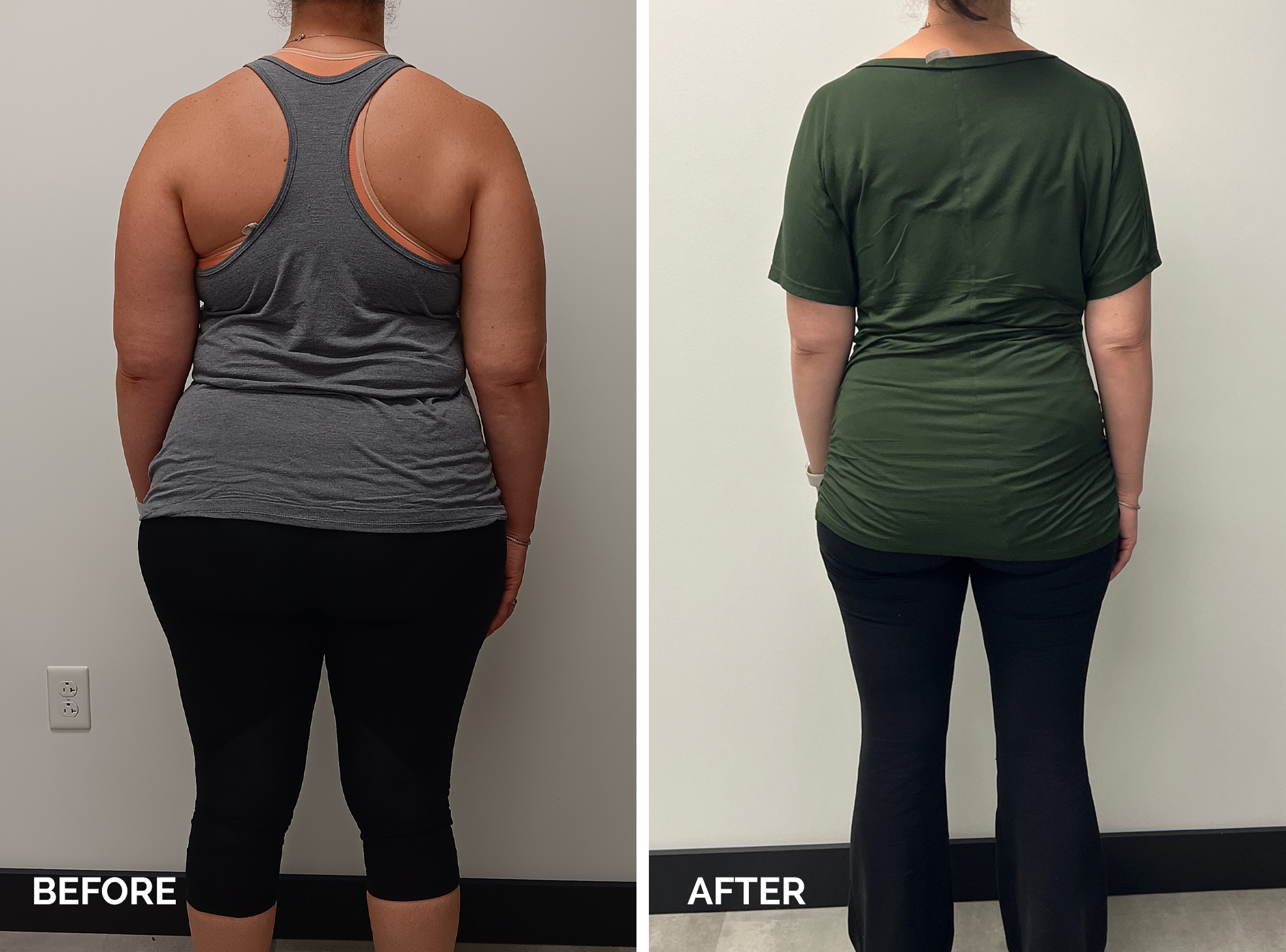 Medical Weight Loss - Before and After - 2