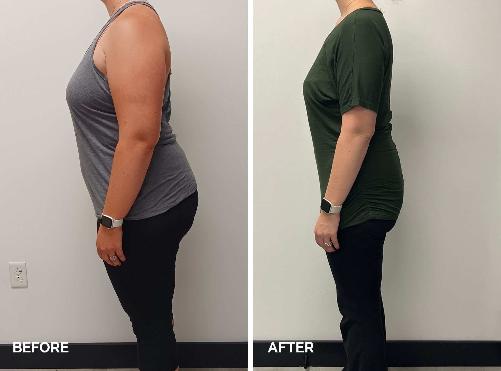 Medical Weight Loss - Before and After - 3