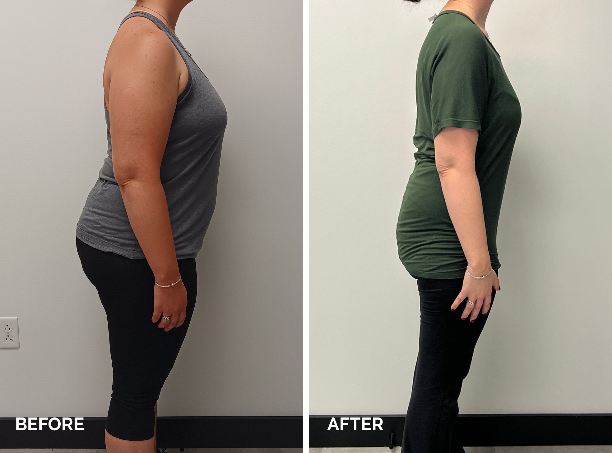 Medical Weight Loss - Before and After - 4