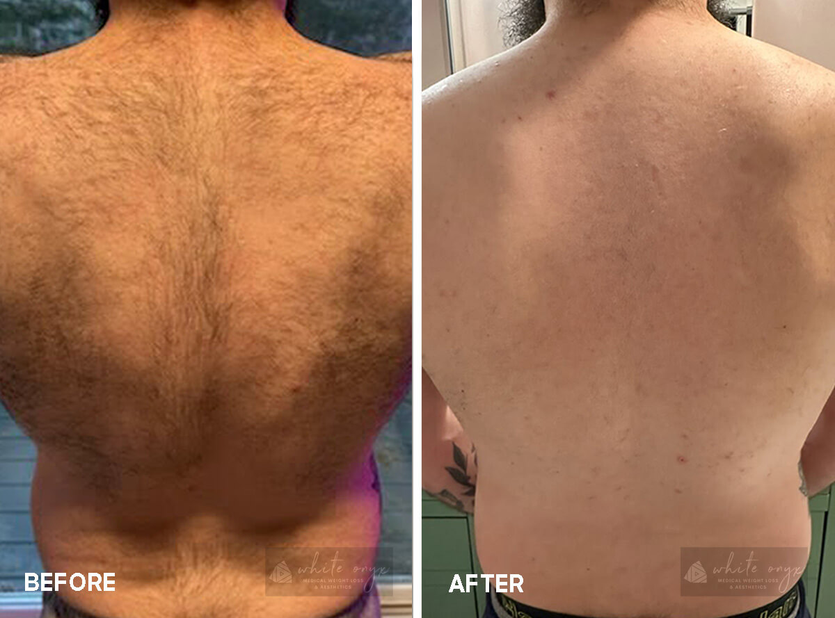 Cervello Laser Hair Removal Before After Results Case - 2