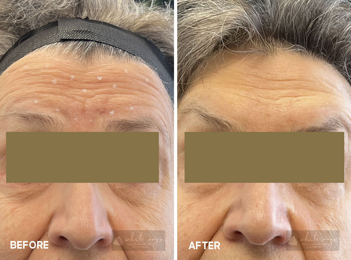 Daxxify Neurotoxin Upper Face and Around the Eyes Before After Results Case - 7, 1