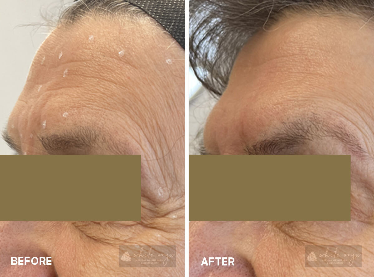 Daxxify Neurotoxin Upper Face and Around the Eyes Before After Results Case - 7, 2