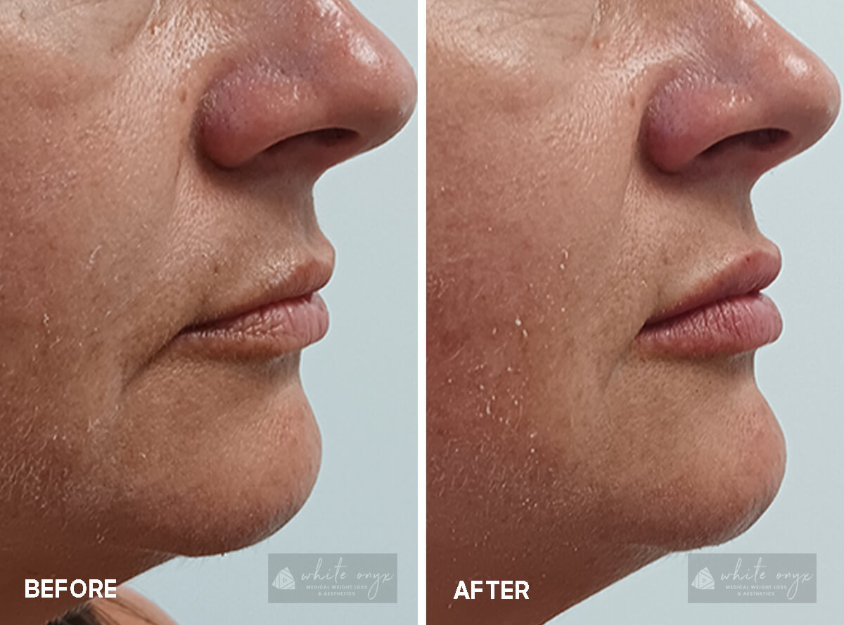 RHA Lips Filler Before After Results Case - 4, 1