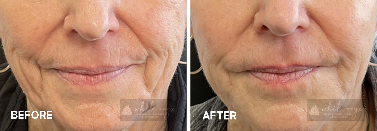 Mid and Lower Facial Rejuvenation with Filler Before After Results Case - 1, 1