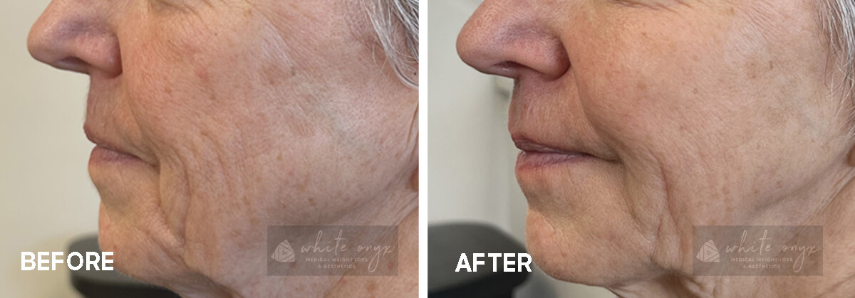Mid and Lower Facial Rejuvenation with Filler Before After Results Case - 1, 2
