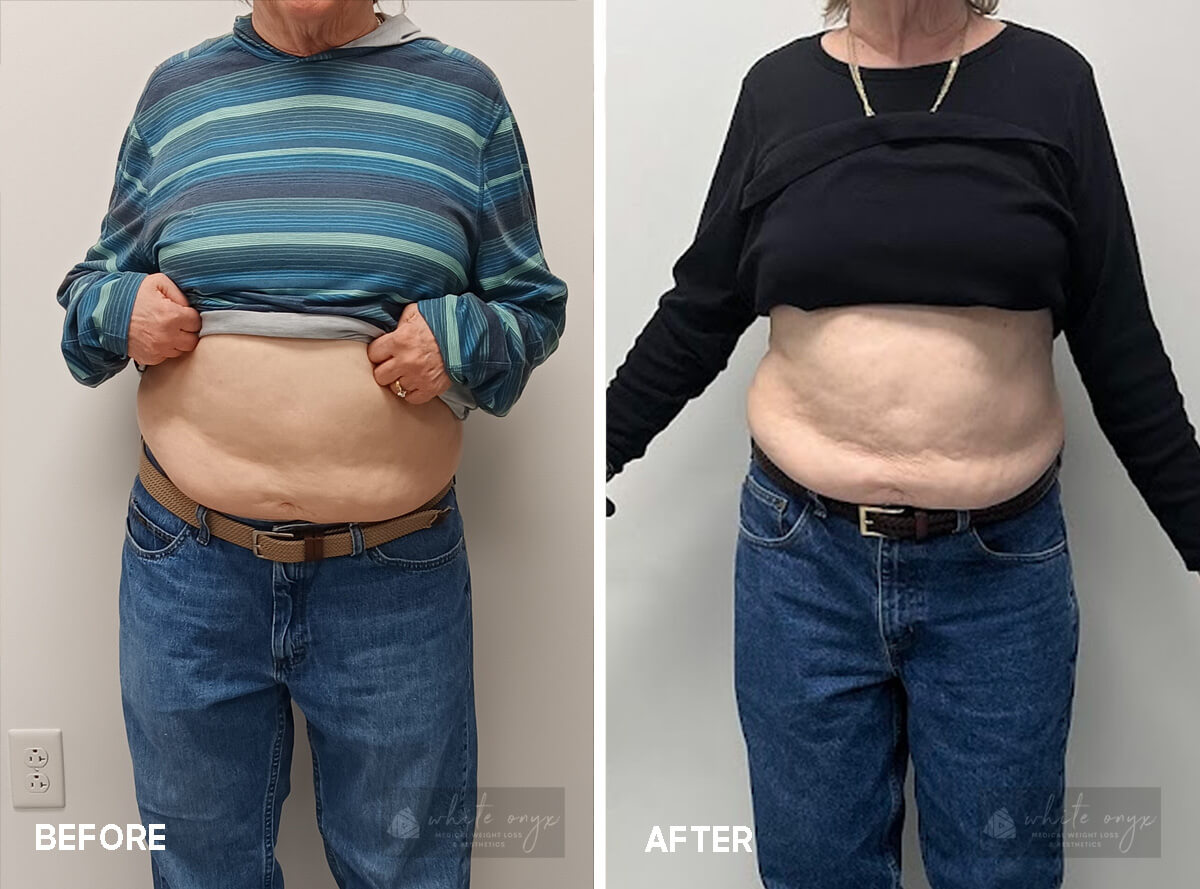 Weight Loss Before After Results Case - 5, 1