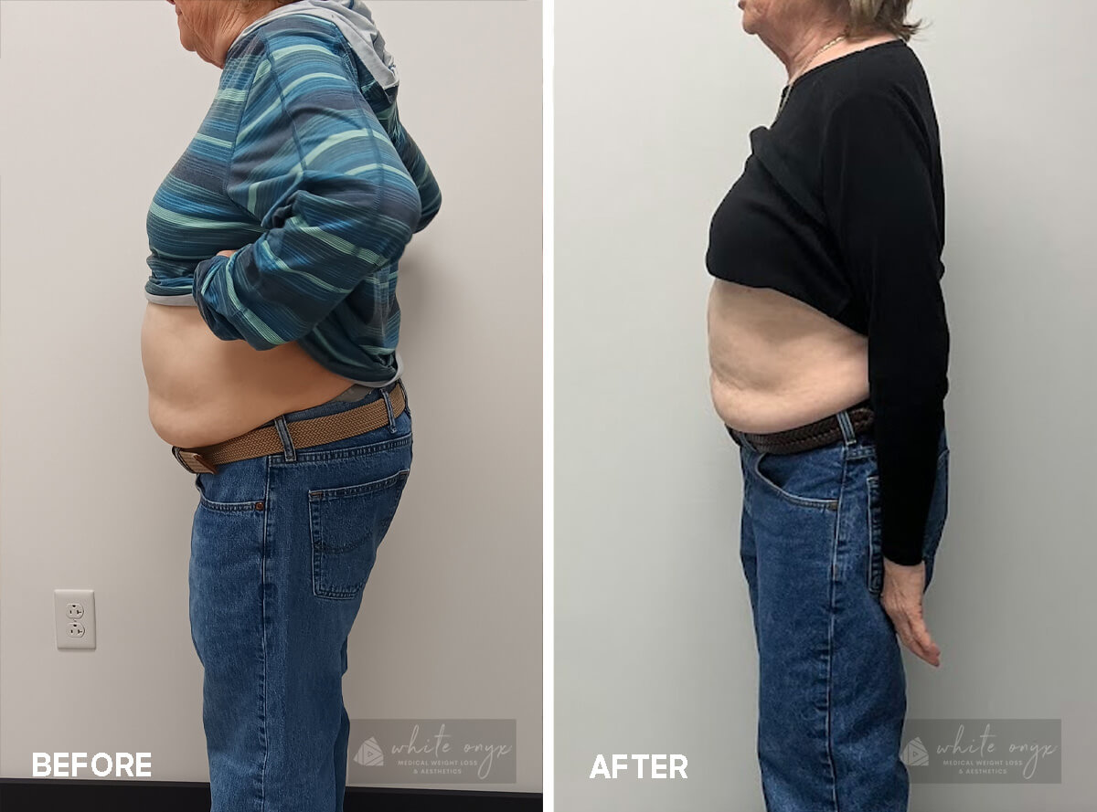 Weight Loss Before After Results Case - 5, 2