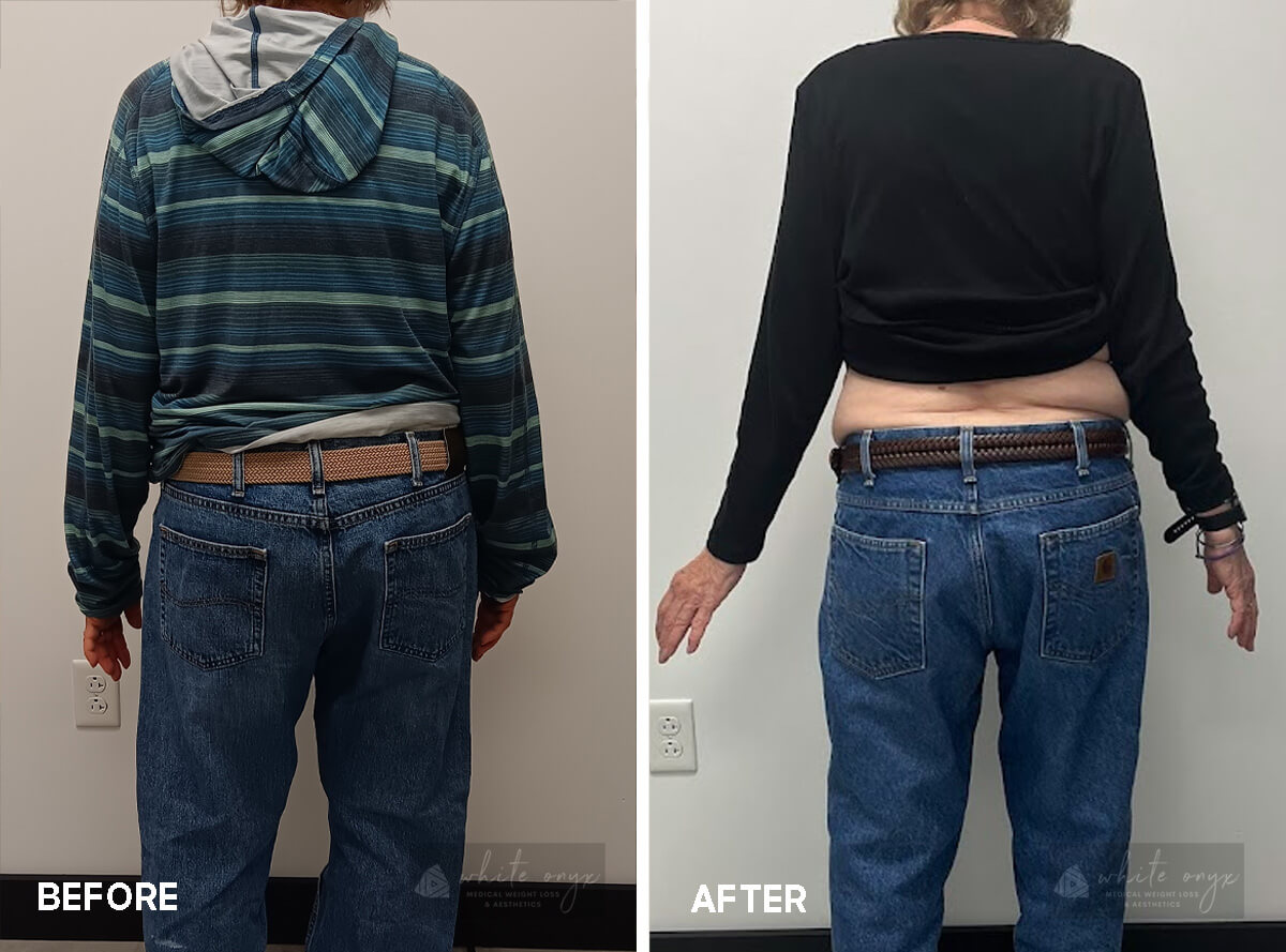 Weight Loss Before After Results Case - 5, 3