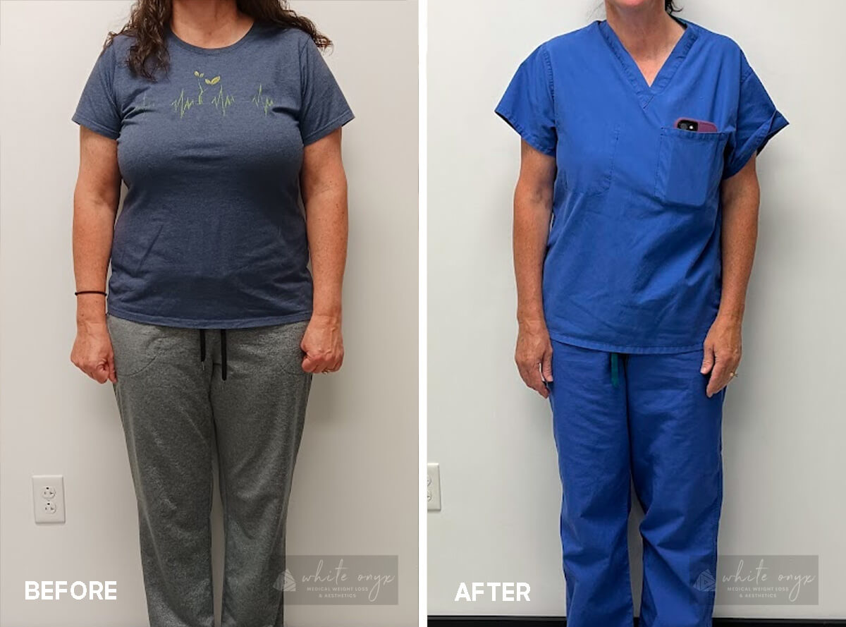 Weight Loss Before After Results Case - 6, 1