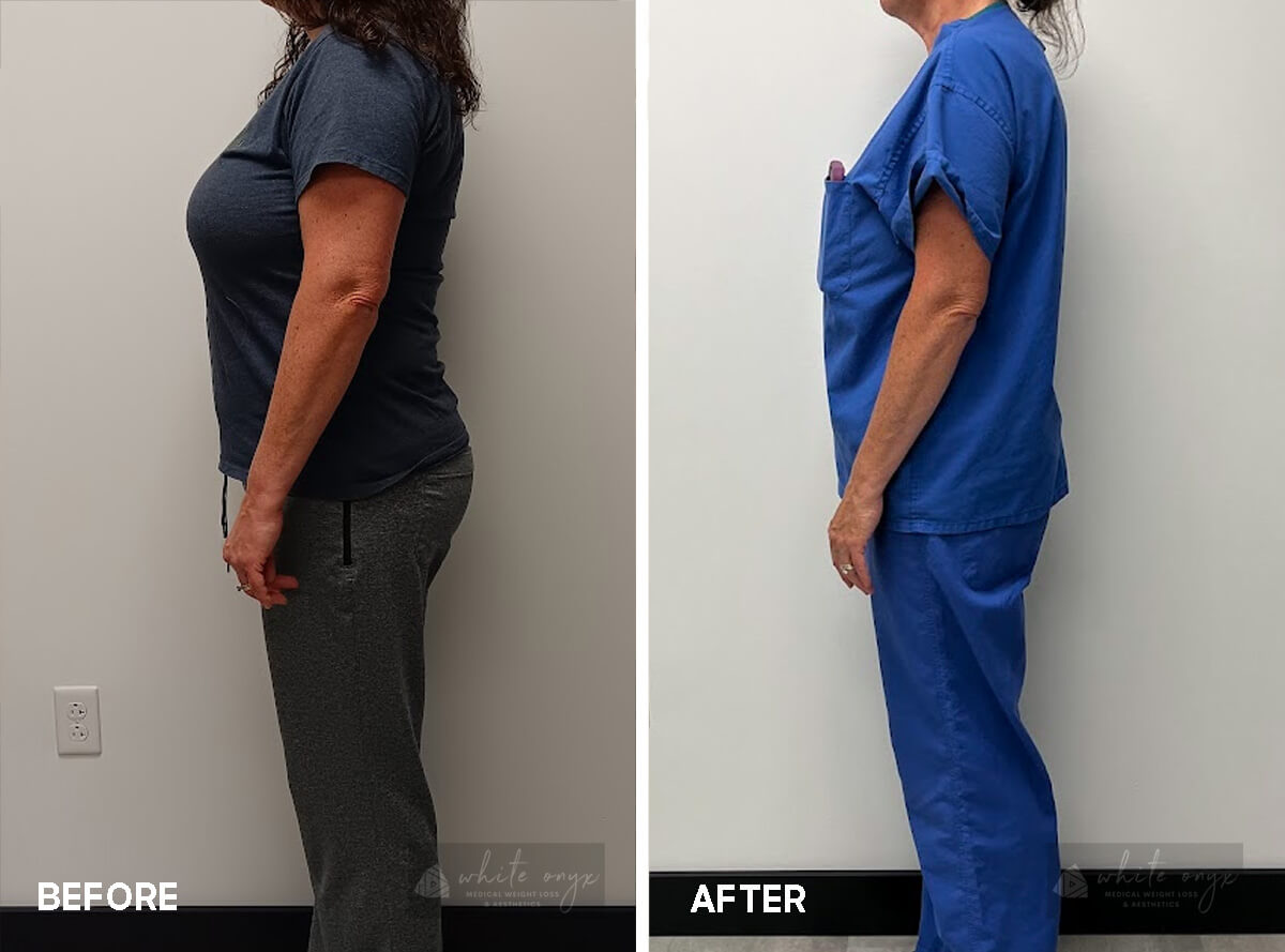 Weight Loss Before After Results Case - 5, 2