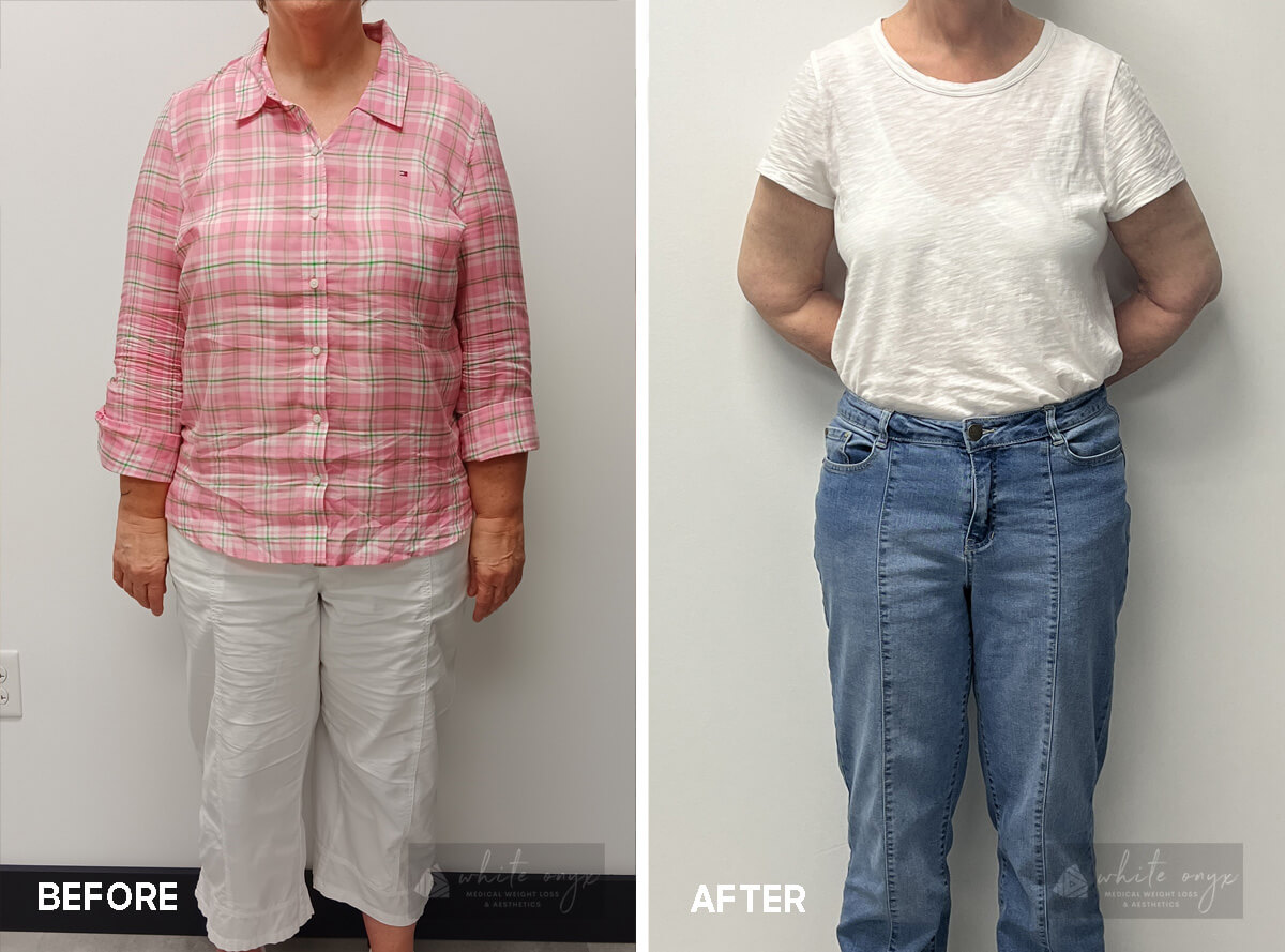 Weight Loss Before After Results Case - 7, 1