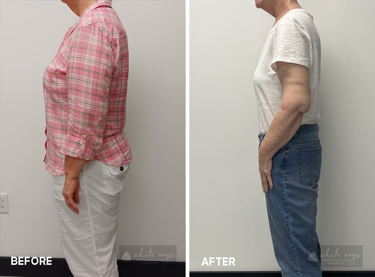 Weight Loss Before After Results Case - 7, 2