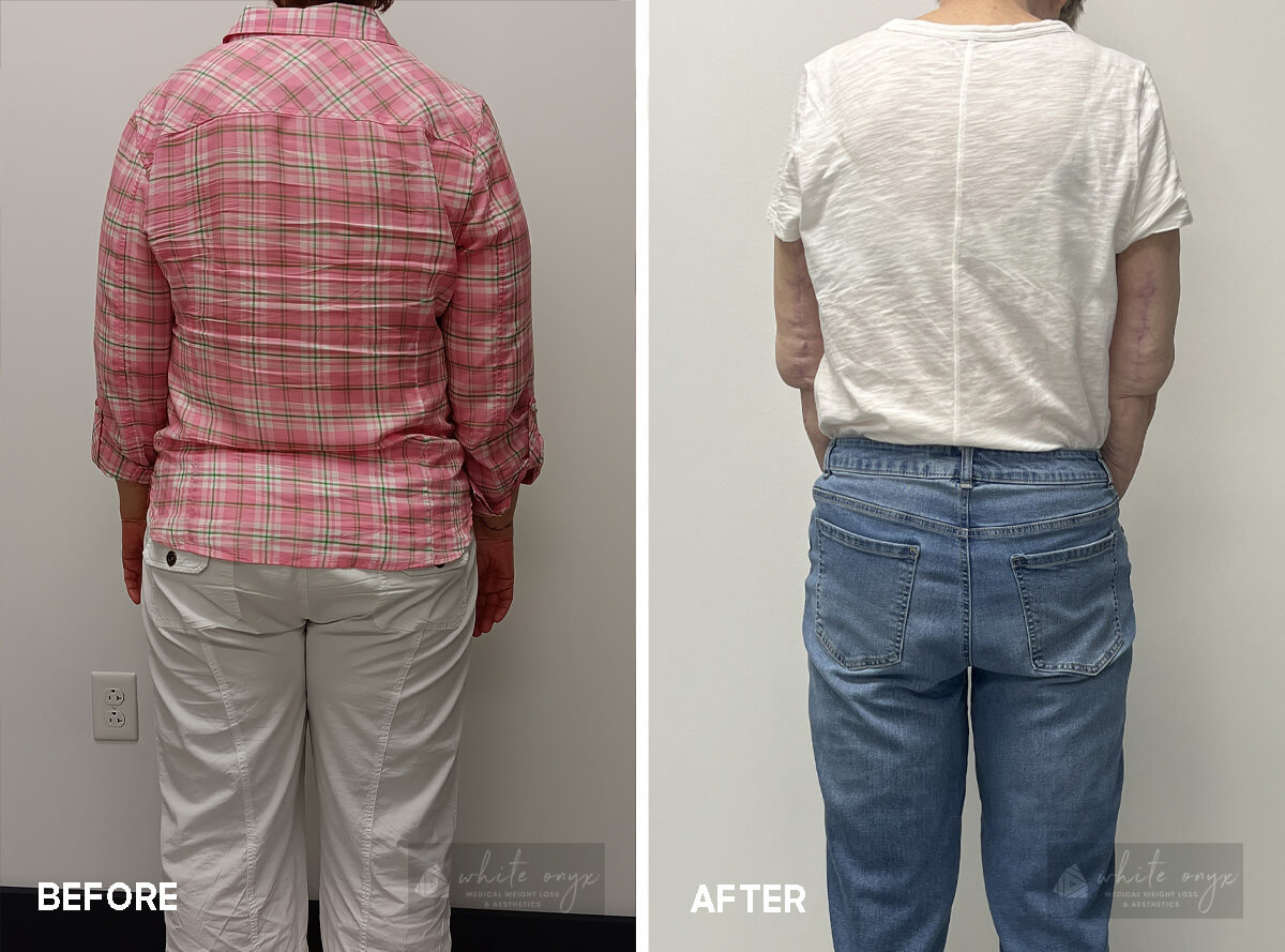 Weight Loss Before After Results Case - 7, 3