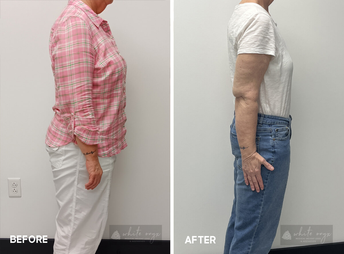 Weight Loss Before After Results Case - 7, 4