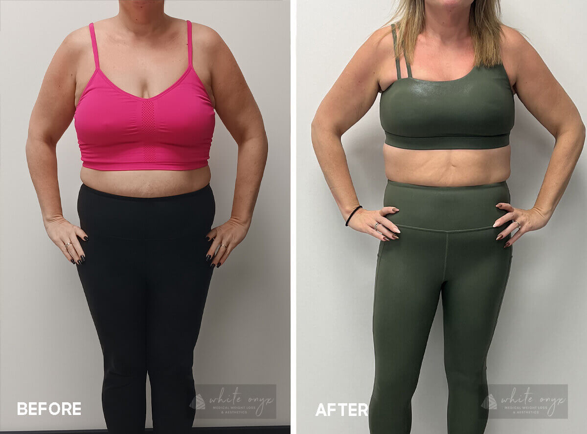 Weight Loss Before After Results Case - 8, 1