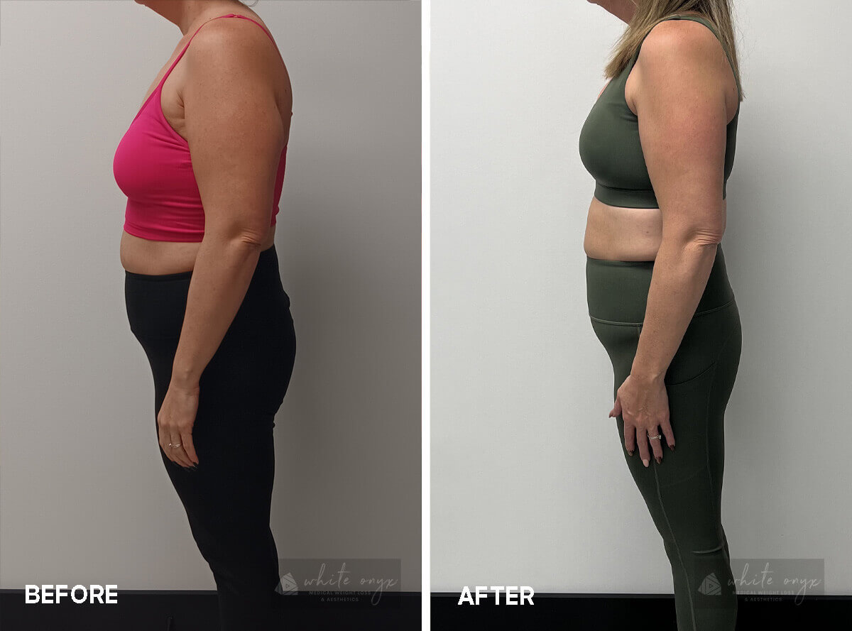 Weight Loss Before After Results Case - 8, 2