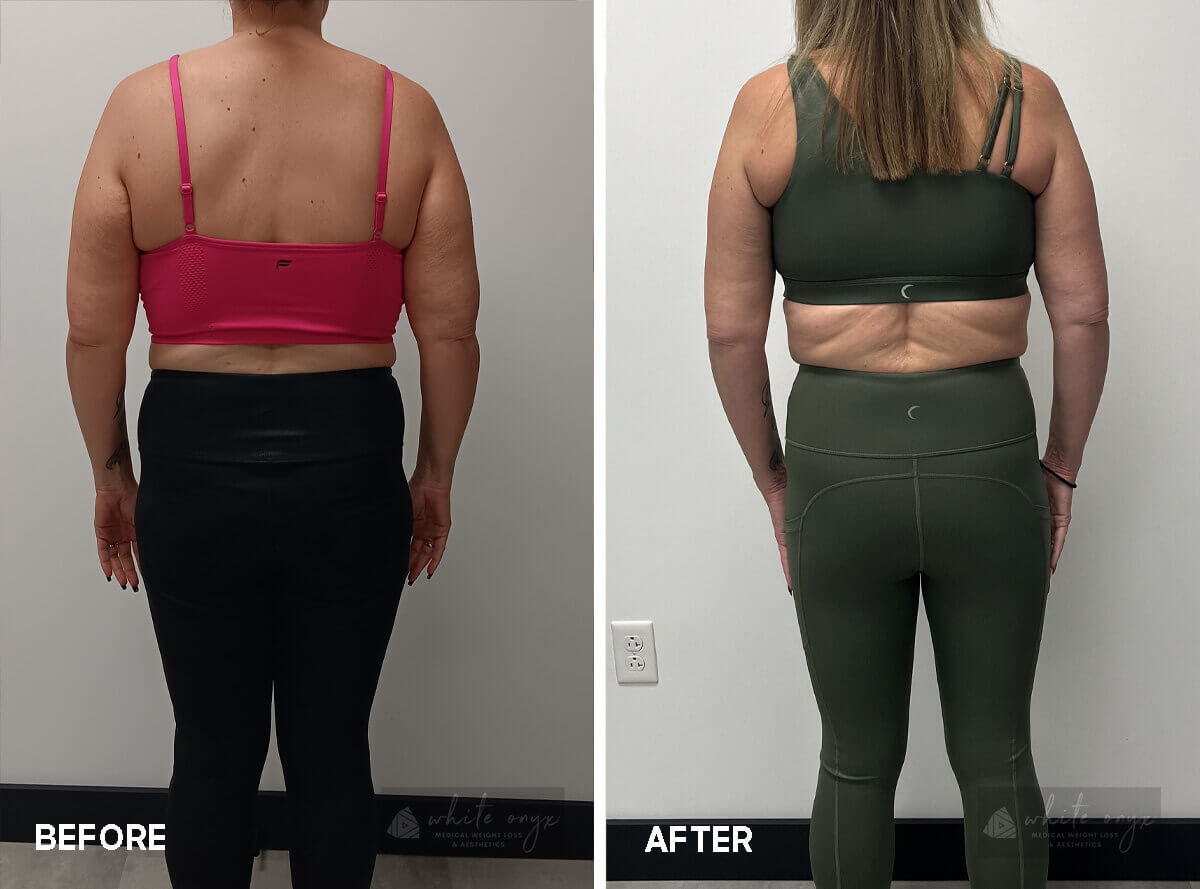 Weight Loss Before After Results Case - 8, 3
