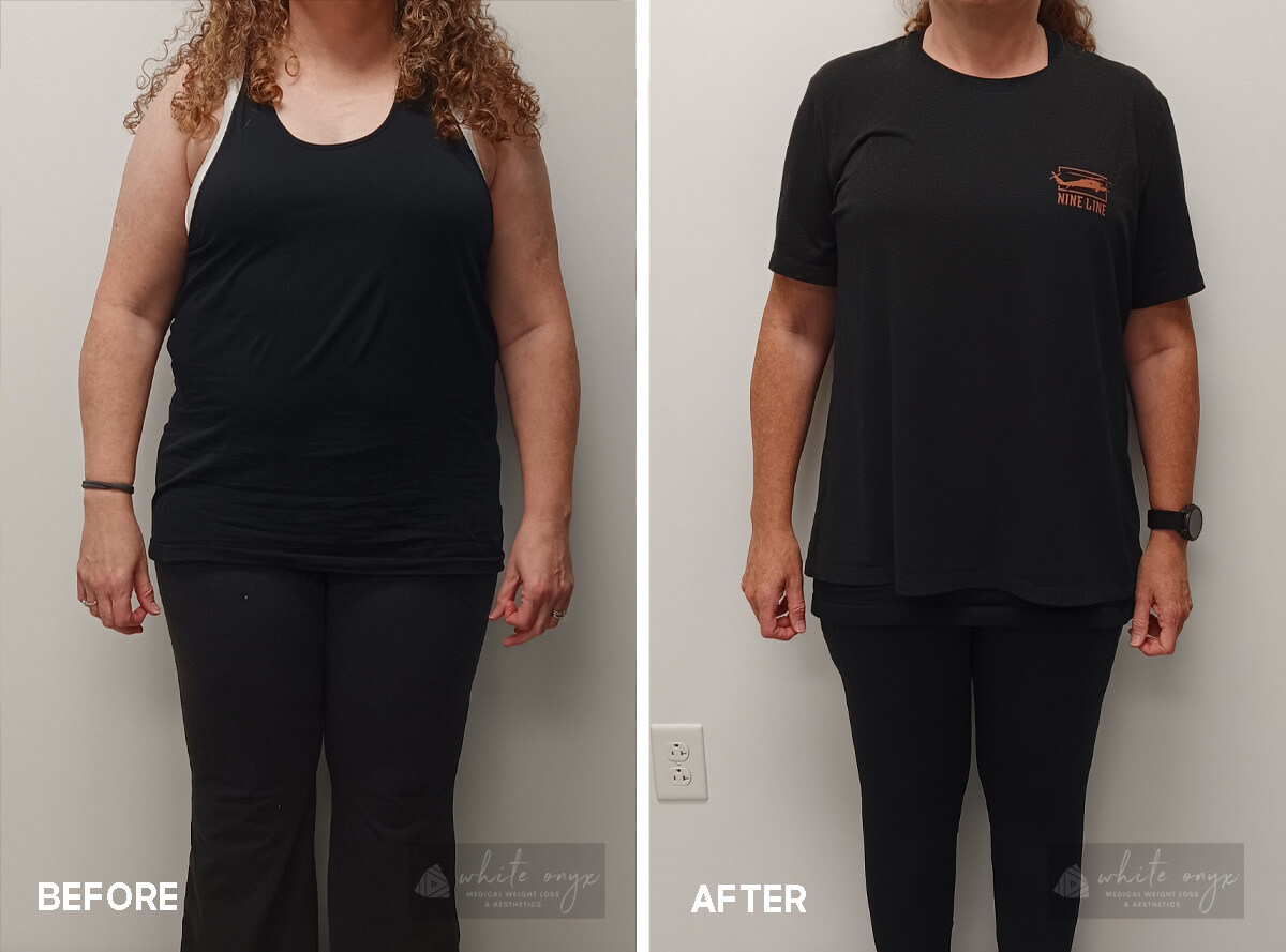 Weight Loss Before After Results Case - 9, 1