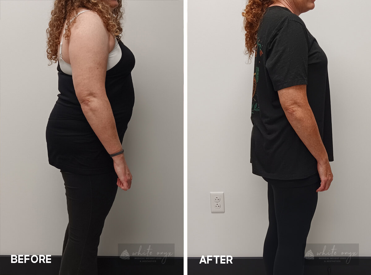 Weight Loss Before After Results Case - 9, 2
