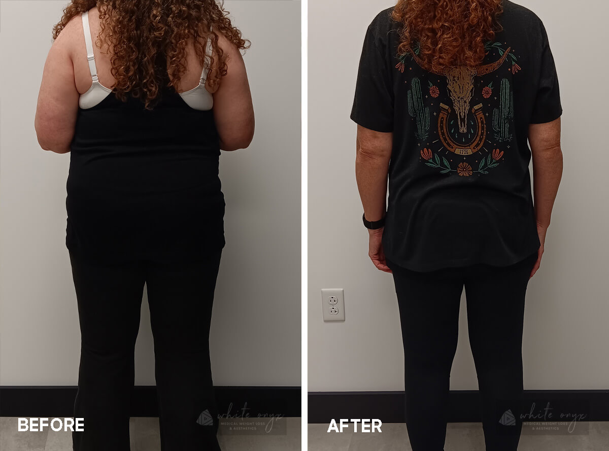 Weight Loss Before After Results Case - 9, 3
