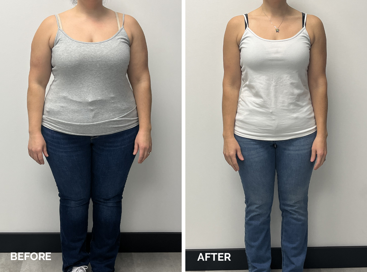 Weight Loss Before After Results Case - 10